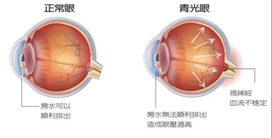 合肥普瑞眼科·青光眼周特辑 | 比青光眼更危险的，是这七大误区