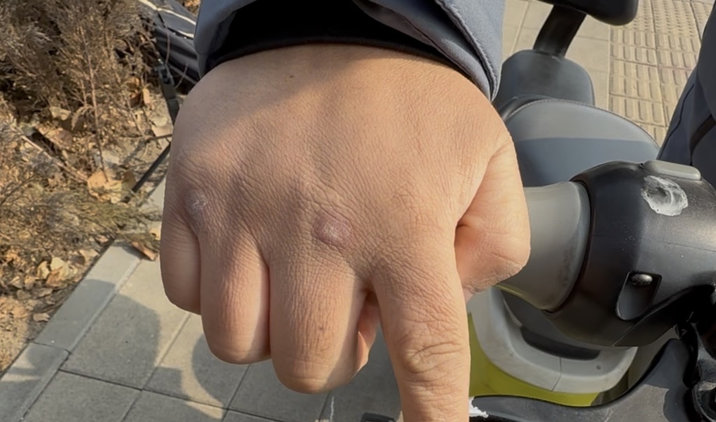 事发数月后，曹先生右手手背的伤疤。