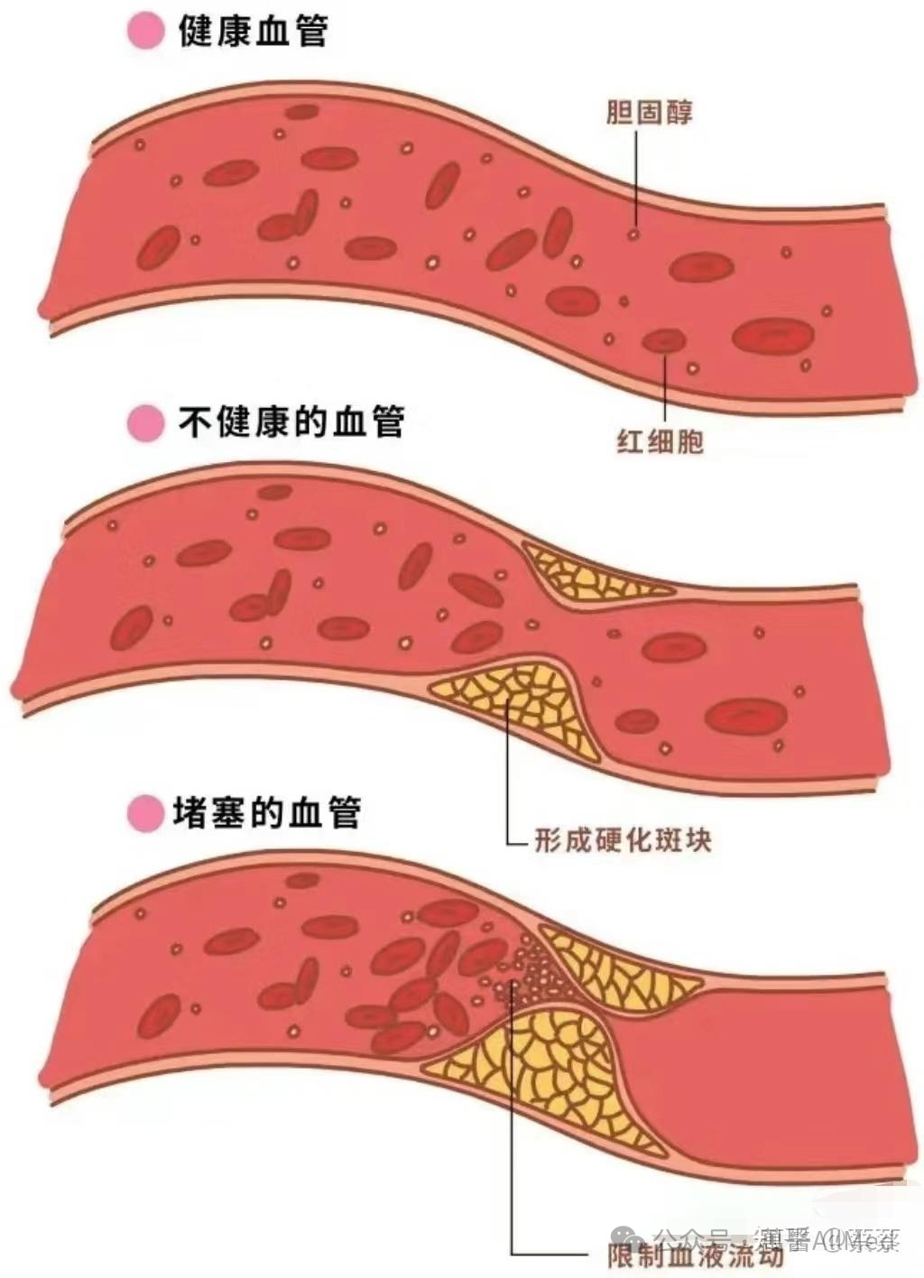 张晋血管堵塞80%,哪些原因造成的?