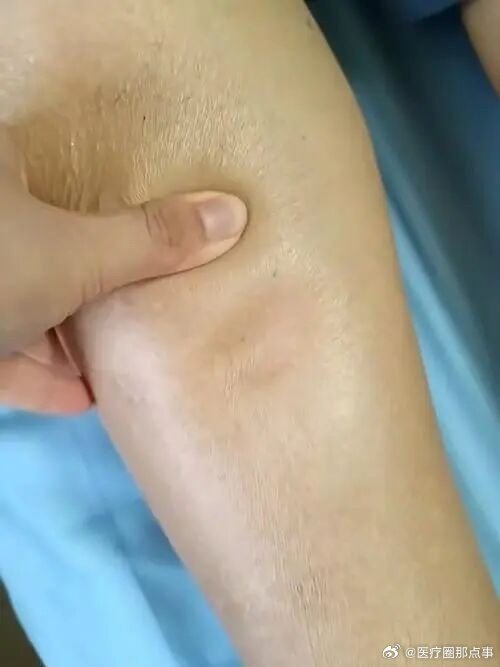 医学上对于吴京这种“慢回弹”水肿现象有哪些可能的解释？