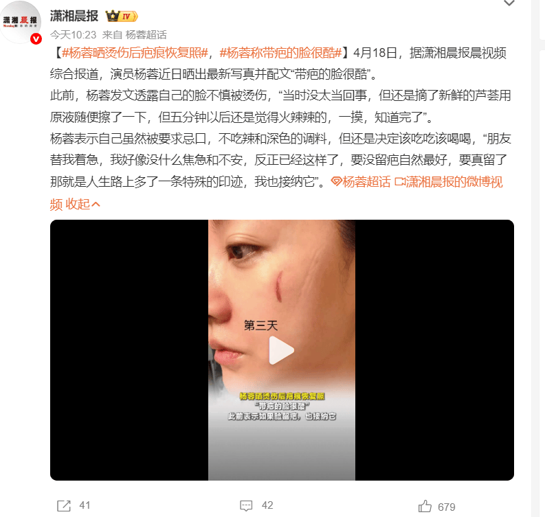 杨蓉晒烫伤后疤痕恢复照称带疤的脸很酷