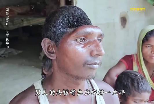 男人的头被寄生虫吃掉一大半，肚子也快被吃空了