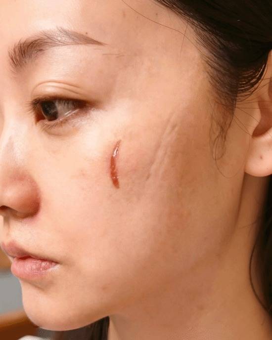 杨蓉晒烫伤疤痕照反击容貌焦虑!二度烫伤还吃辣喝酒,45岁活成叛逆女王