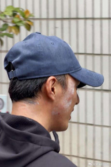 叶祖新这次古装头套胶水受伤的具体情况有多严重？