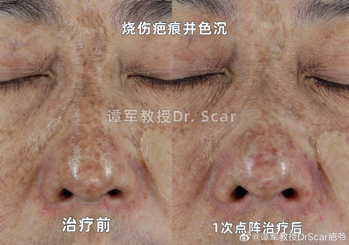 杨蓉后续采用了哪些科学方法来修复烫伤疤痕？