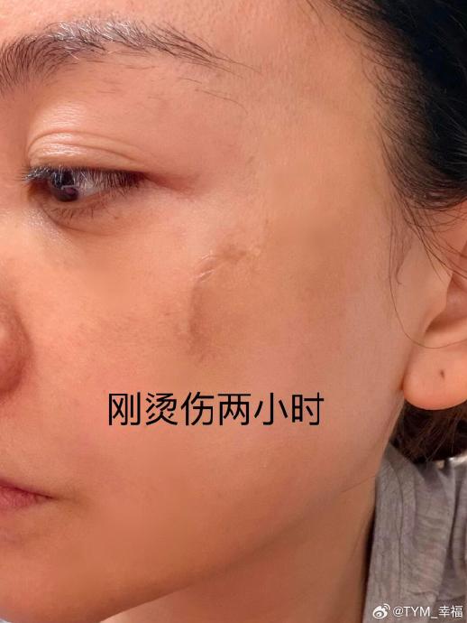 杨蓉烫伤9天后宣布“带疤很酷”，为何获全网点赞？