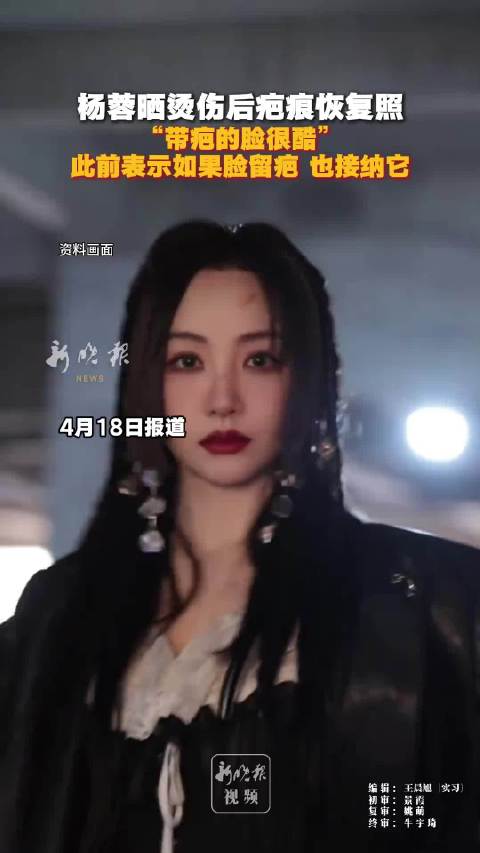 杨蓉面部烫伤恢复中，疤痕渐好转获网友叮嘱