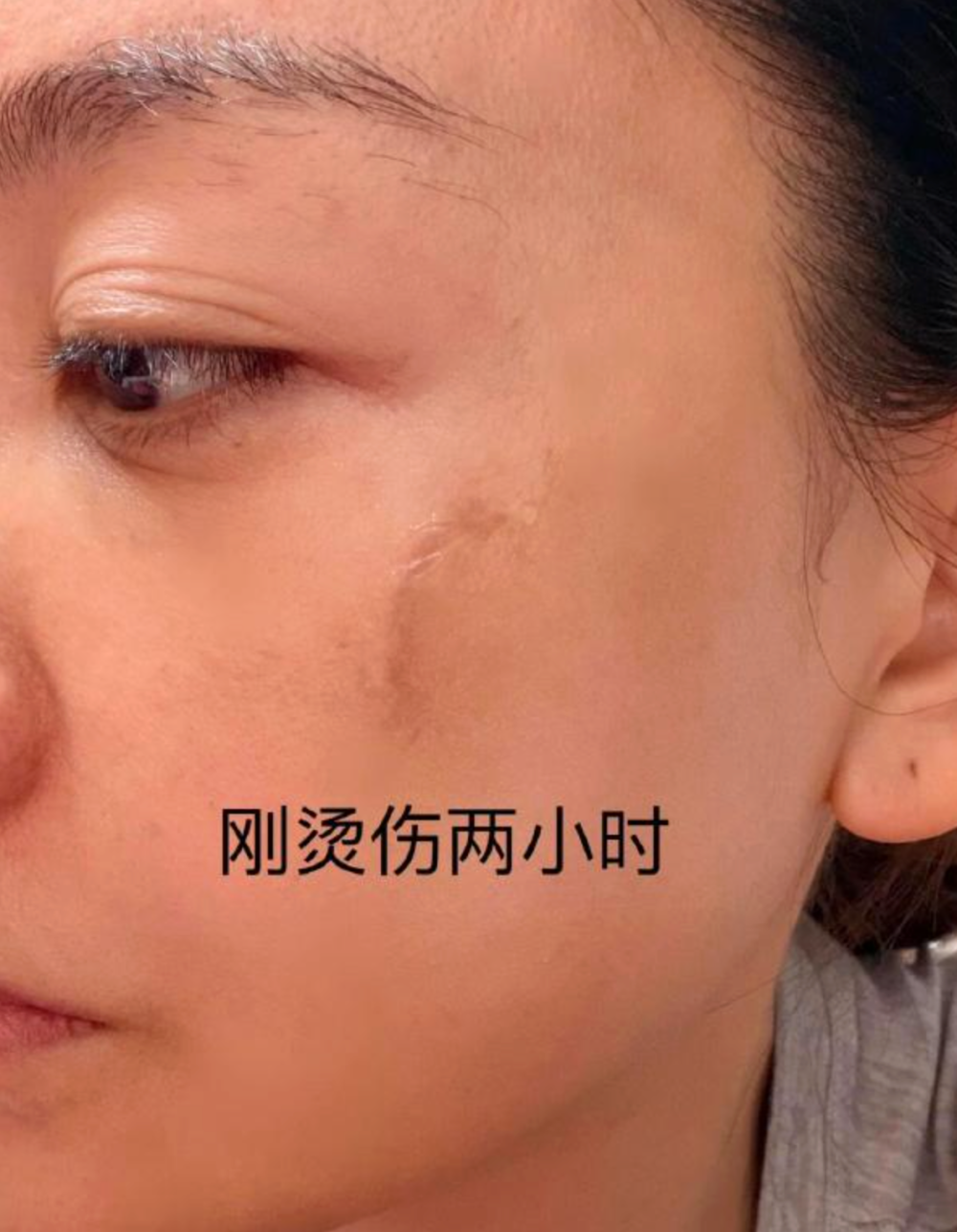 烫伤9天后疤痕基本消退!杨蓉晒“带疤的脸”直言很酷_新闻
