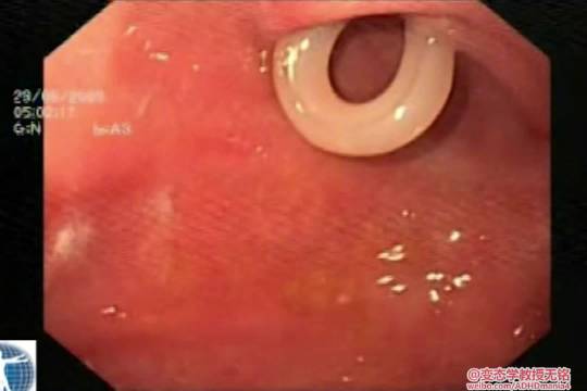 医生内窥镜下取出患者腹中蛔虫