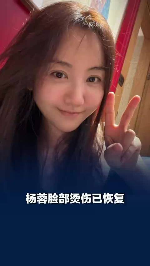 杨蓉脸部烫伤已恢复