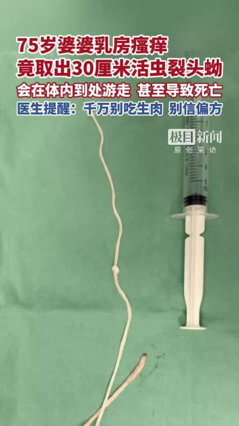 罕见！75岁老人胸部奇痒竟藏30cm寄生虫