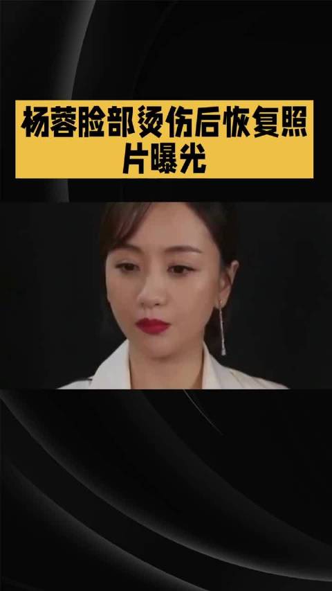 杨蓉烫伤恢复良好素颜无痕，称伤疤为勋章
