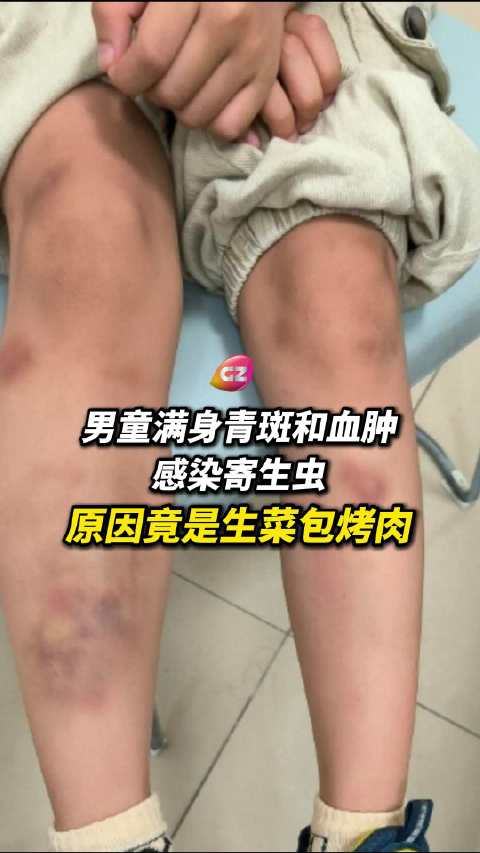 6岁男童生吃生菜感染寄生虫致全身血肿