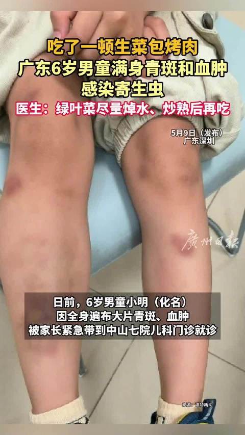 6岁男童吃生菜后血肿感染寄生虫6岁男童生吃生菜感染寄生虫
