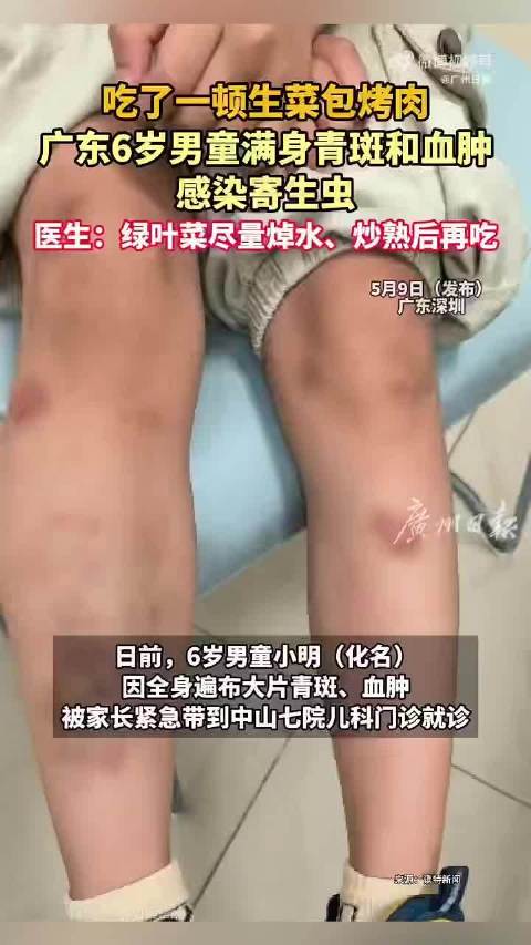 6岁男童生食生菜感染寄生虫致血肿