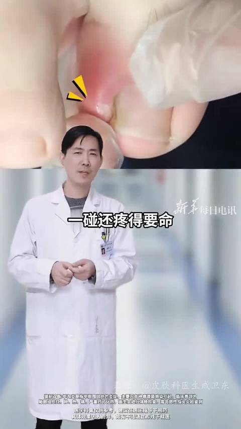 甲沟炎患者看过来！教你三步自己在家也能处理