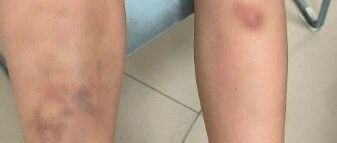 广东6岁男童吃生菜包烤肉后，全身出现大片青斑、血肿.......紧急提醒→