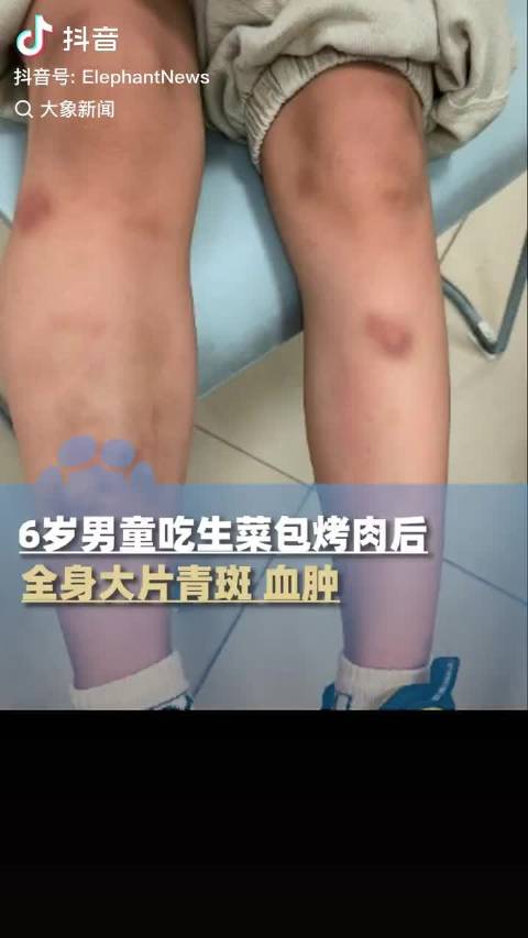 6岁男童生食未洗净生菜感染寄生虫引血肿