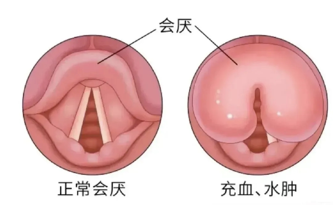 喉咙痛居然能致命？医生提醒：有一种喉咙痛，必须马上去医院