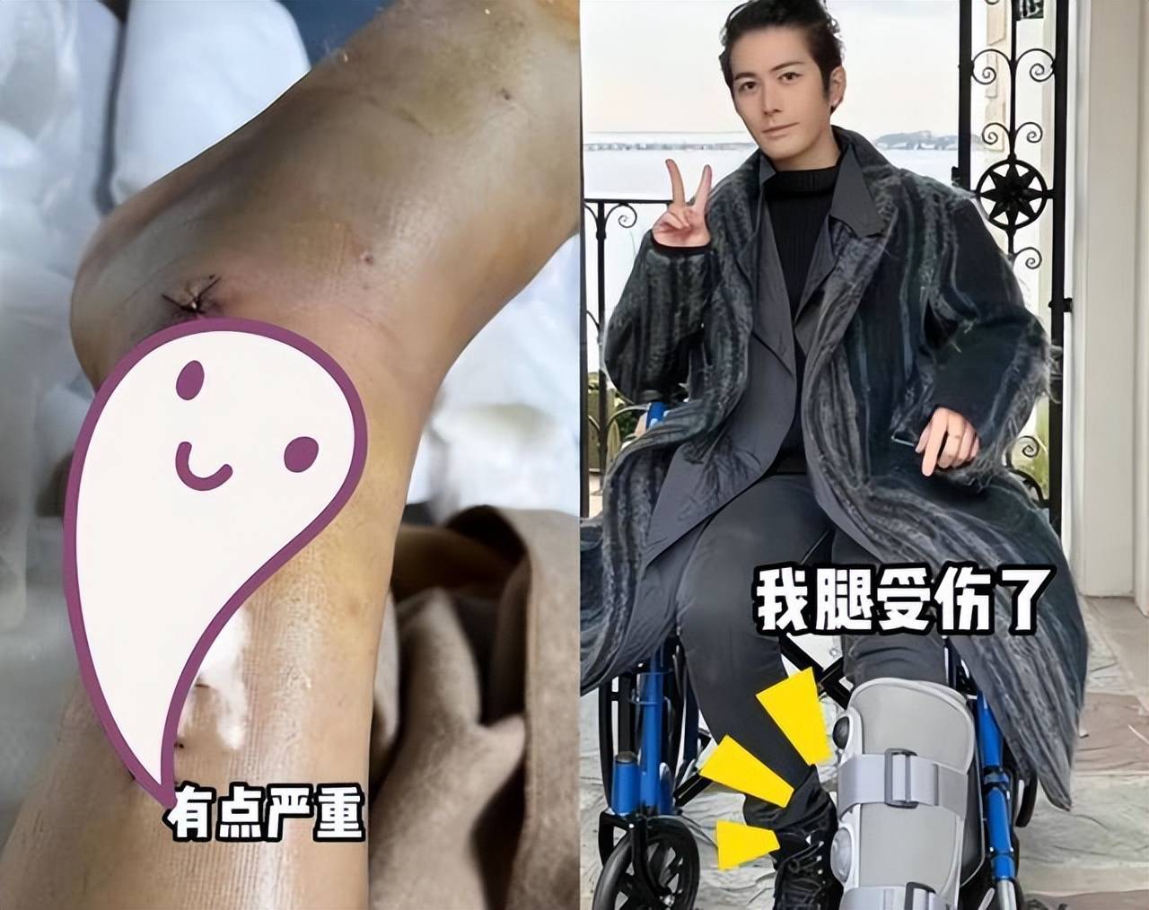 陈学冬近况曝光,右脚惊险保住,3年不停做手术,微博动态已清空