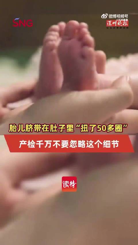 广东孕妇脐带扭转50圈致胎儿缺氧，医联体紧急抢救成功