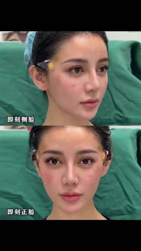 美女：42岁做完微调，朋友都说我像迪丽热巴！ 你们看看效果怎么样？