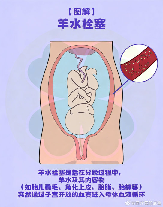 洛阳这名羊水栓塞产妇最终苏醒了吗