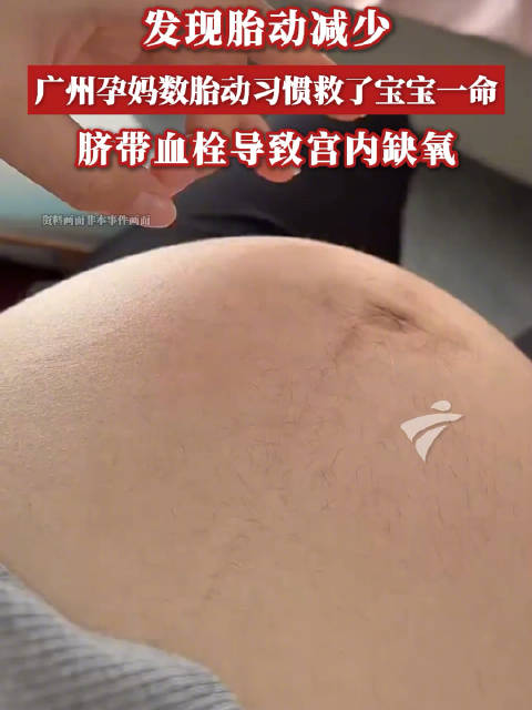 发现胎动减少，广东孕妈数胎动习惯救了宝宝一命，脐带血栓导致宫内缺氧