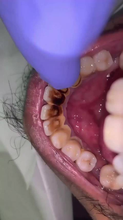 来看洗牙，解压