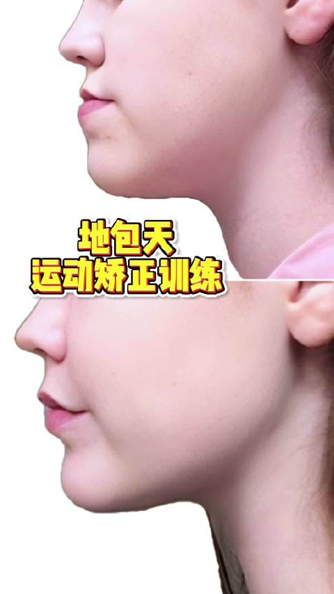 地包天运动矫正