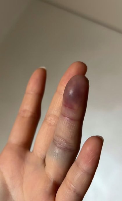 丁程鑫的左手骨裂伤情目前恢复得怎么样了? 丁程鑫的左手骨裂伤情目前恢复得怎么样了?