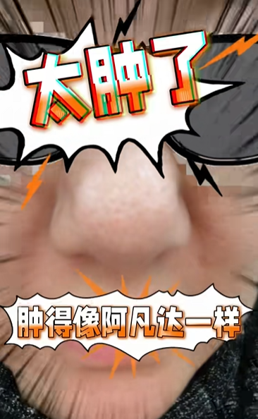 浙江女子花万元缩鼻却“变异”成阿凡达，说话久了还漏液!当事人:一直喊停，还是全打进去…医院回应_新闻