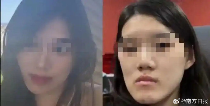 24岁女孩仅2毫米地包天,为何被建议做正颌手术? 24岁女孩仅2毫米地包天,为何被建议做正颌手术?