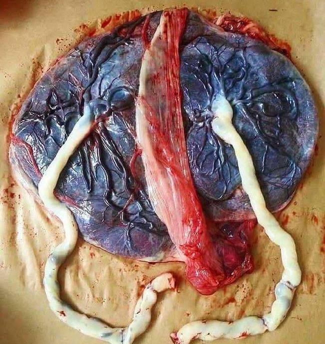 双绒双羊双胎与单绒毛膜双胎有何区别? 双绒双羊双胎与单绒毛膜双胎有何区别?