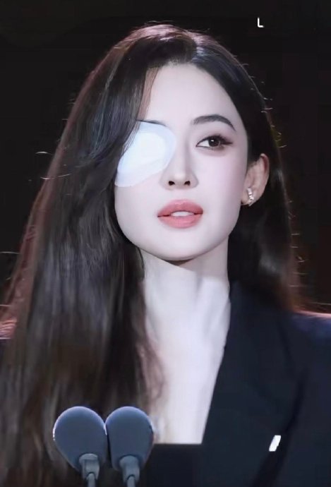 娜扎眼疾和单眼皮有关系吗? 娜扎眼疾和单眼皮有关系吗?