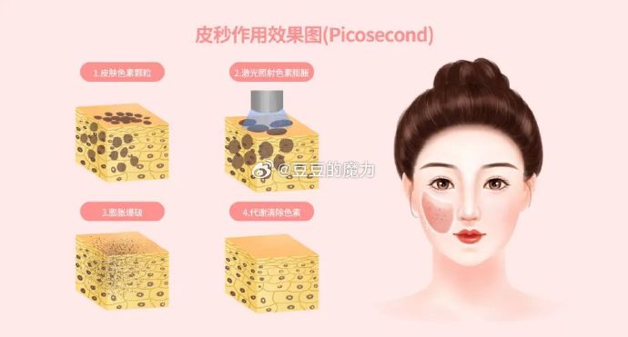 皮秒激光祛斑的原理是什么? 皮秒激光祛斑的原理是什么?