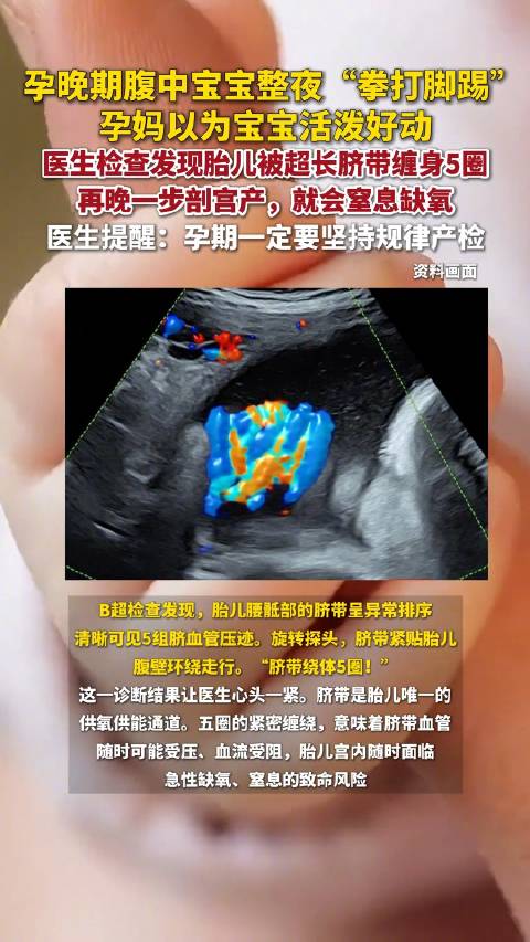 胎儿整夜胎动竟是脐带绕体5圈险窒息