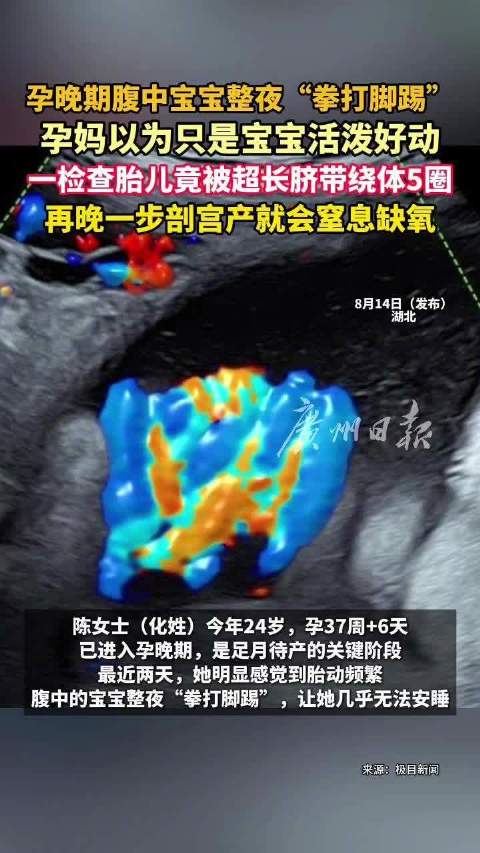 胎儿被脐带缠5圈拳打脚踢向妈妈求救 医生：再晚一步剖宫产就会窒息缺氧