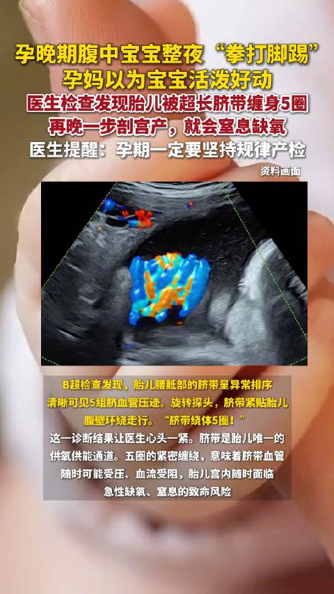 胎儿胎动飙升脐带绕体5圈险窒息