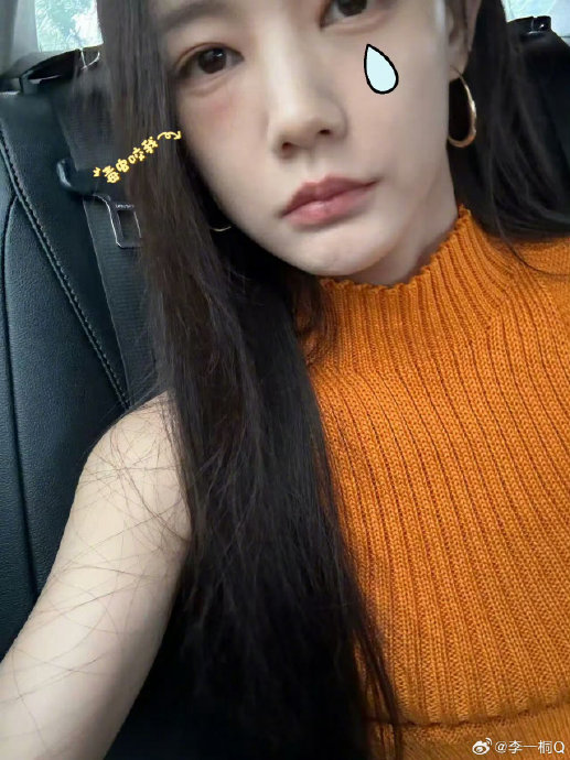 李一桐被毒虫咬脸红肿，网友喊话快就医