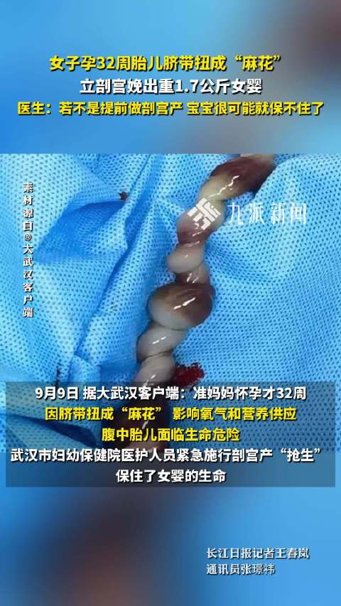 女子孕32周剖宫产救出麻花脐带宝宝，医生：脐带扭转约40圈，呈现异常紫黑色