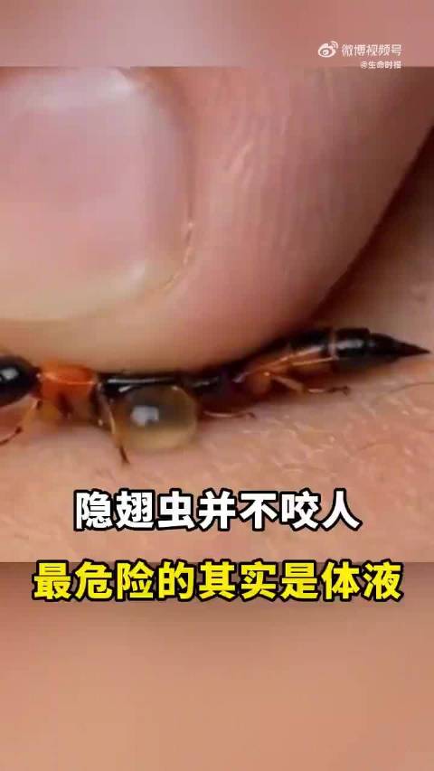 隐翅虫不咬人最危险的其实是体液