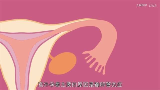 警惕会伪装的宫外孕