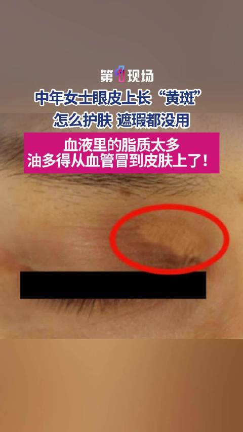 45岁女子眼皮长黄斑