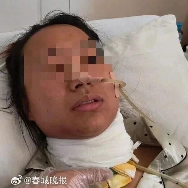 28岁女子骑车时被30余厘米长竹棍贯穿脖颈,大脑缺血近50分钟,没有脑梗瘫痪 28岁女子骑车时被30余厘米长竹棍贯穿脖颈,大脑缺血近50分钟,没有脑梗瘫痪
