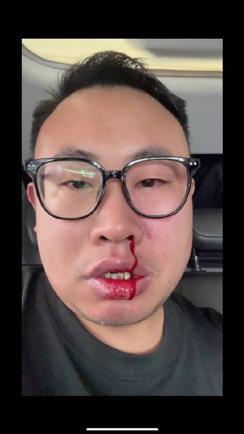 聋哑司机未戴助听器载客出车祸，滴滴非营运车辆保险拒赔