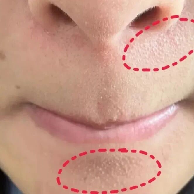 真的想问:下巴凸起的小颗粒,到底是什么呀? 真的想问:下巴凸起的小颗粒,到底是什么呀?