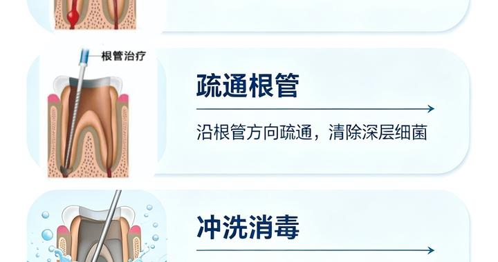 根管治疗不是“杀神经”那么简单!一文看懂救牙神器 根管治疗不是“杀神经”那么简单!一文看懂救牙神器