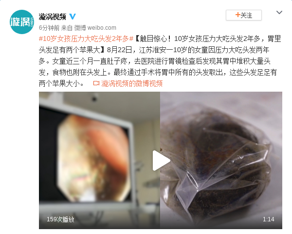 10岁女孩压力大吃头发2年多 胃里头发足有两个苹果大