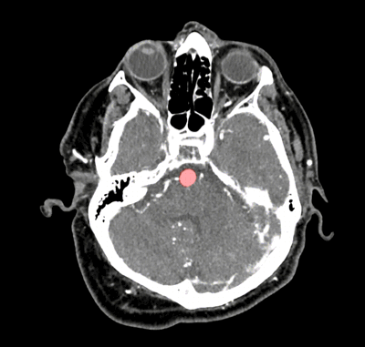在脑部扫描中，HeadXNet使用透明的红色高光指示动脉瘤的位置。（图片来源：Allison Park）